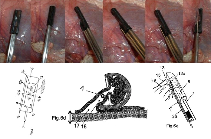 AttachLifter for
            pericardial access (PeriAttacher)